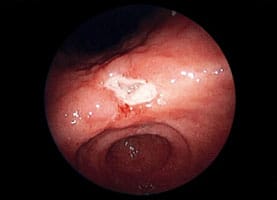 胃潰瘍の症例